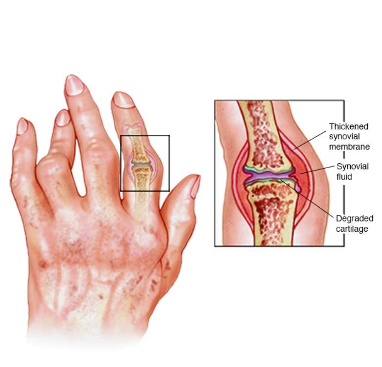 A kéz leggyakoribb betegségei Csukló izomgyulladás