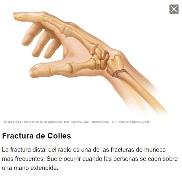 proteína Marca comercial mecanógrafo Fracturas de mano - Tarragona | Traumatólogos