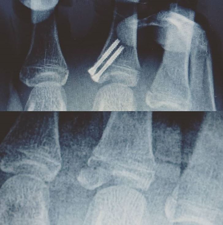 "Epifisiolisis tipo III de falange proximal de un dedo de la mano en paciente de 16 años