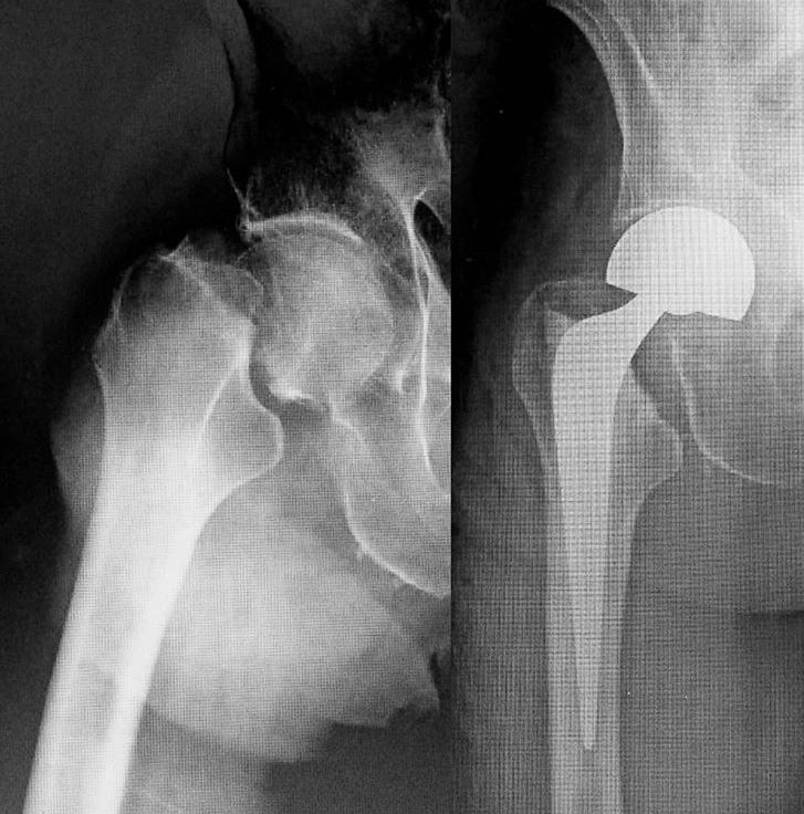 Paciente de 75 años con fractura subcapital de fémur.