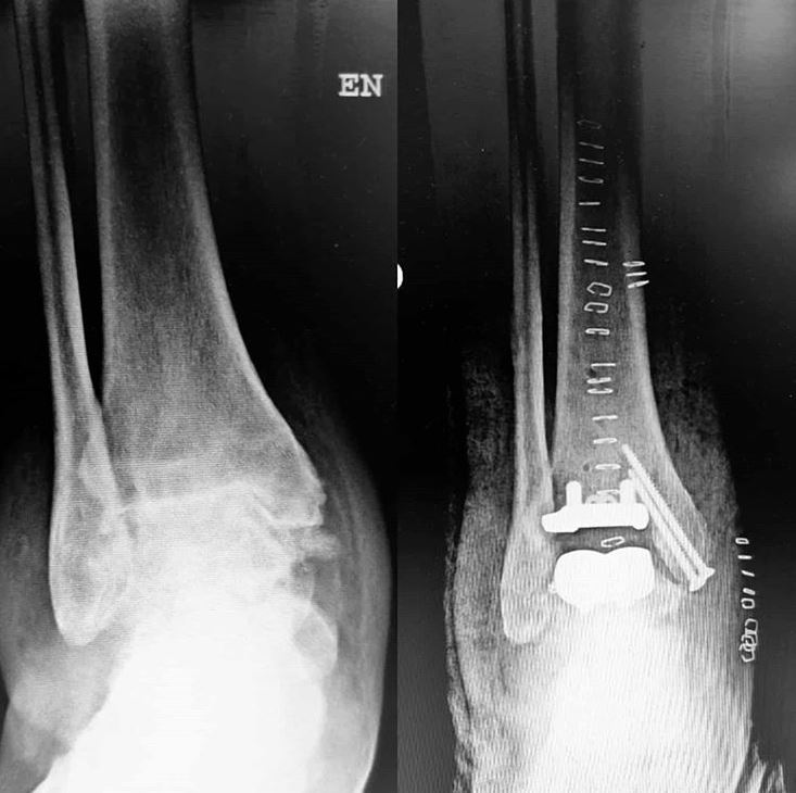 Artroplastia total de tobillo en el tratamiento de de la artrosis primaria tibio-peroneo-astragalina