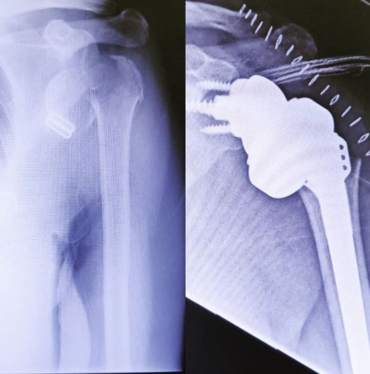 Artroplastia total invertida de hombro en el tratamiento de las fracturas de húmero proximal. 