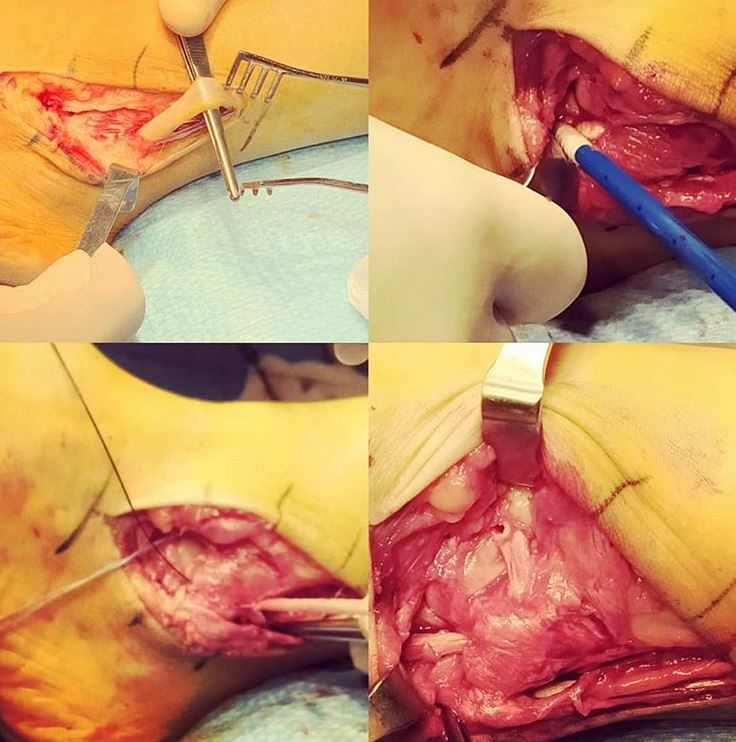 Plastia anatómica de reconstrucción de complejo ligamentario lateral de tobillo