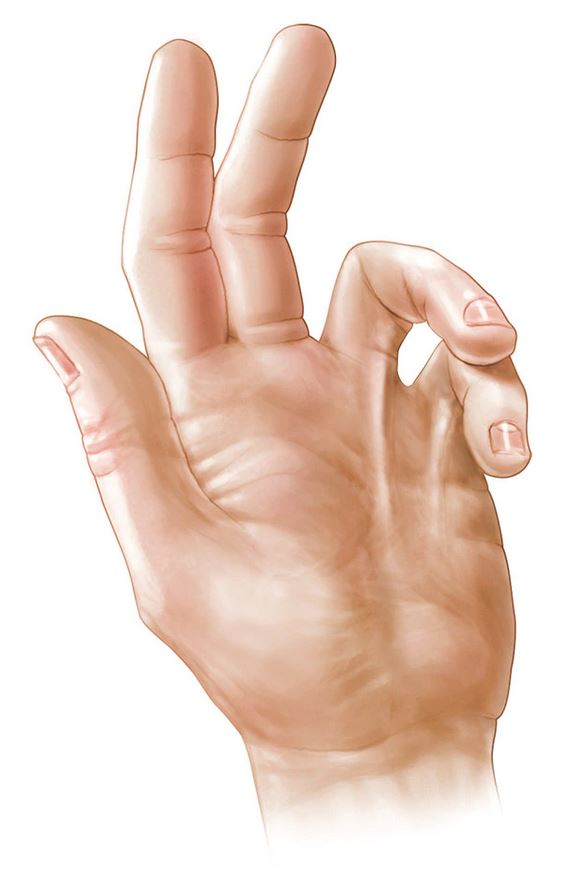 Dupuytren S Contracture Causes And Symptoms Inspirati vrogue.co